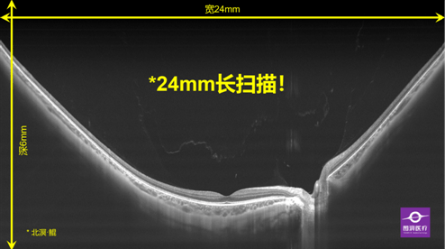 尿毒癥最新消息,尿毒癥最新消息，研究突破與未來治療展望