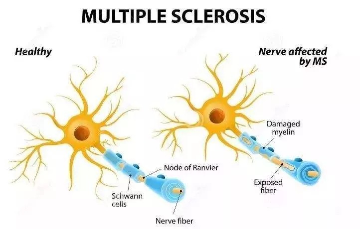 多發(fā)性硬化最新新藥,多發(fā)性硬化最新新藥，重塑治療格局的希望之光